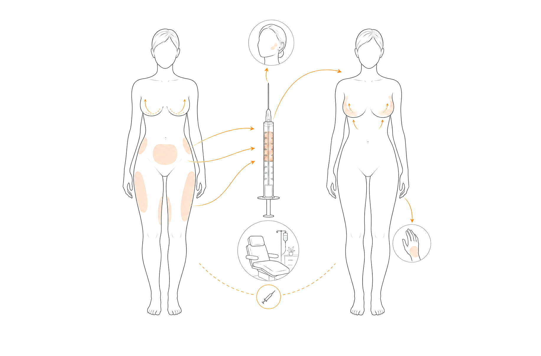 Lipofilling in conbination